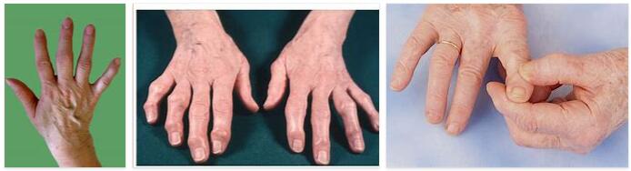 Hand Osteoarthritis Definition and Meaning