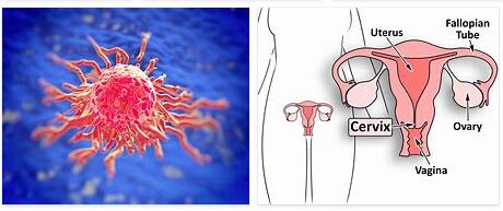Cervical Cancer Definition and Meaning